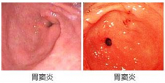 厦门看胃窦炎要去哪个医院