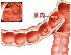 厦门那家医院看肠息肉很好