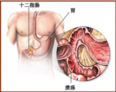 厦门十二指肠溃疡要怎么治