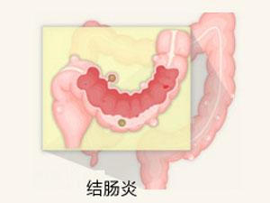 厦门治疗结肠炎哪个医院好